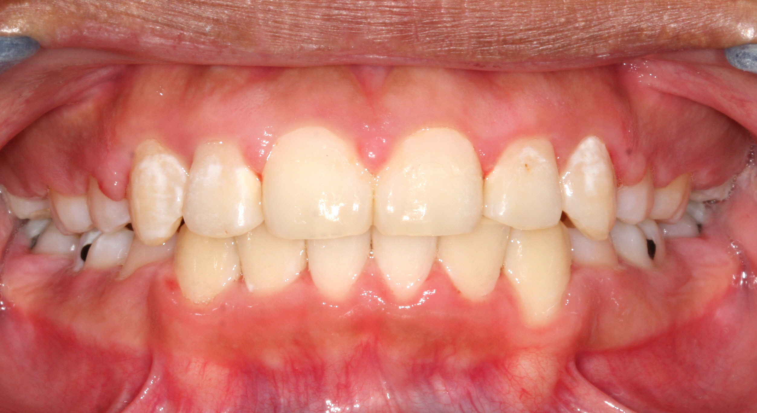 Case 1 - Front View - After