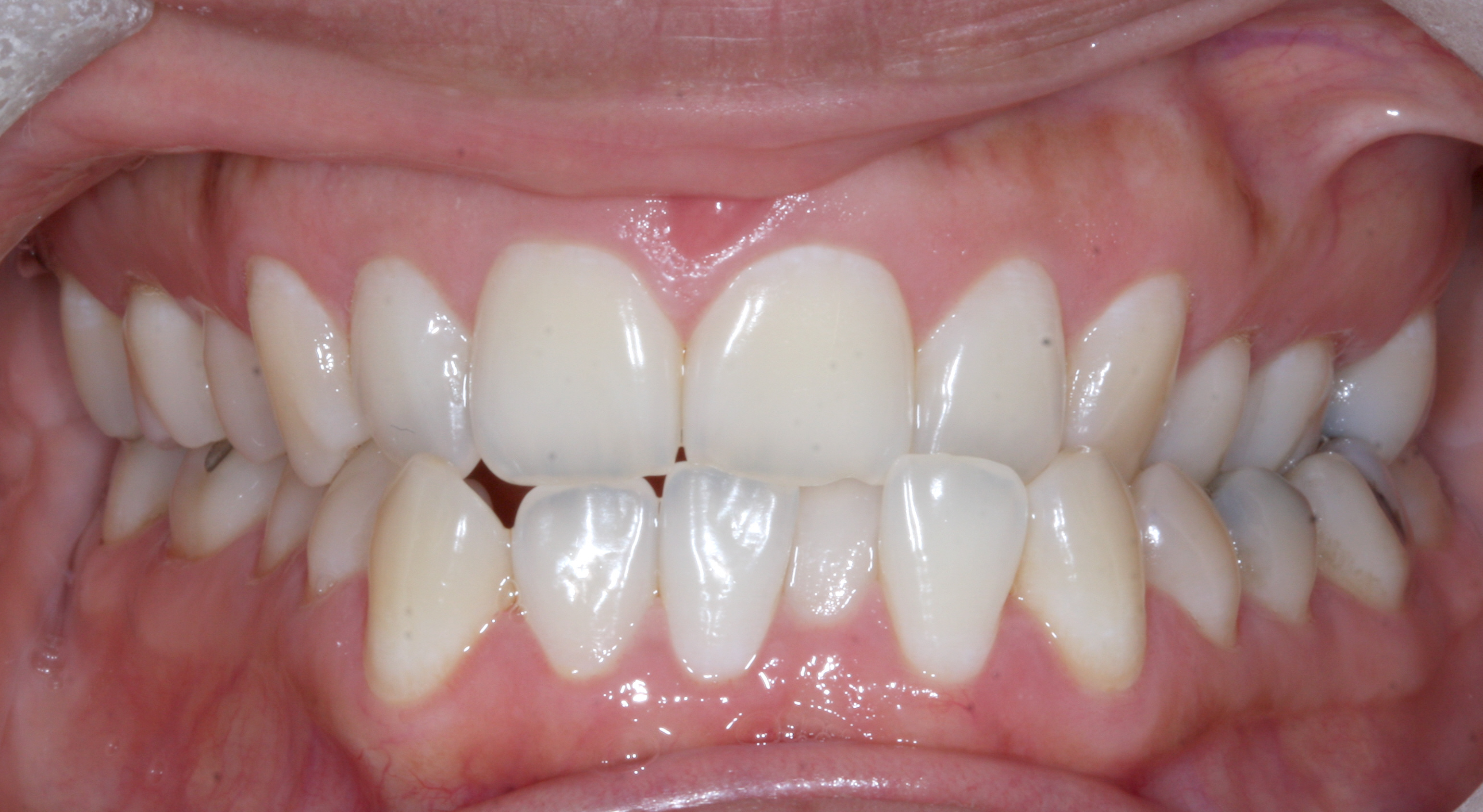 Case 3 - Front View - Before